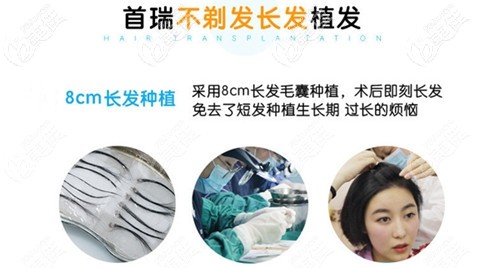 首瑞的不剃發(fā)長發(fā)植發(fā)技術(shù)