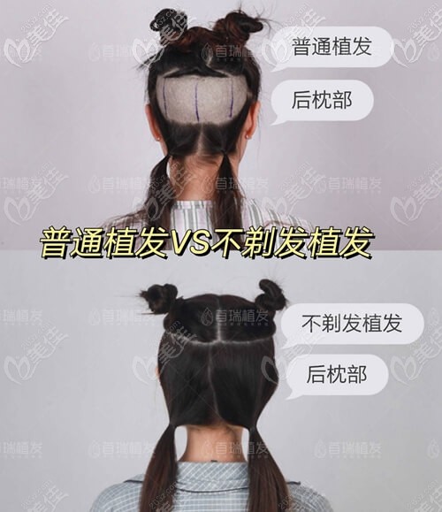 不剃發(fā)植發(fā)和剃發(fā)植發(fā)區(qū)別