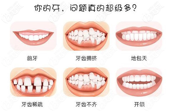 該做牙齒矯正的牙齒問題