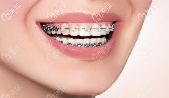 番禺區(qū)三仁口腔的正畸特價項目