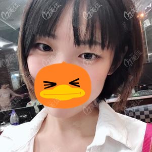 在福州格萊美做全切雙眼皮前 在福州格萊美做全切雙眼皮前