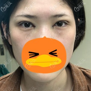 在福州格萊美手術(shù)當(dāng)天 在福州格萊美手術(shù)當(dāng)天