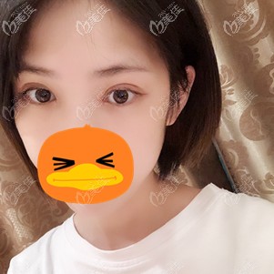 在福州格萊美做全切雙眼皮術(shù)后7天 在福州格萊美做全切雙眼皮術(shù)后7天