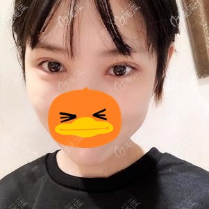 在福州格萊美做全切雙眼皮術(shù)后2周 在福州格萊美做全切雙眼皮術(shù)后2周