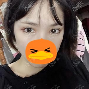 在福州格萊美做全切雙眼皮術(shù)后1個(gè)月 在福州格萊美做全切雙眼皮術(shù)后1個(gè)月