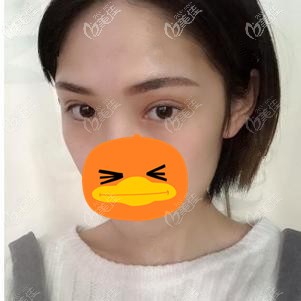 在福州格萊美做全切雙眼皮術(shù)后2個(gè)月 在福州格萊美做全切雙眼皮術(shù)后2個(gè)月