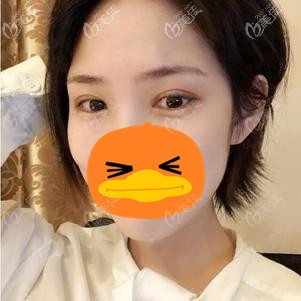 在福州格萊美做全切雙眼皮術(shù)后3個(gè)月 在福州格萊美做全切雙眼皮術(shù)后3個(gè)月