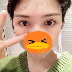 在福州格萊美做全切雙眼皮術(shù)后半年 在福州格萊美做全切雙眼皮術(shù)后半年