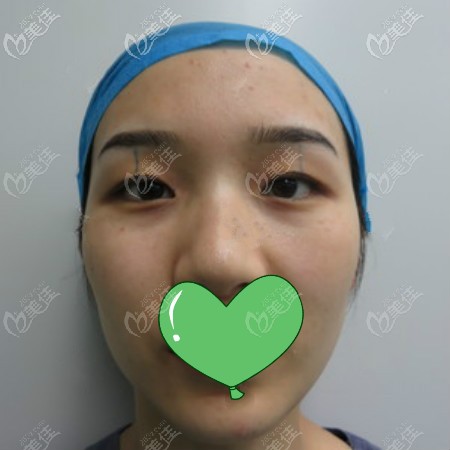 做全切雙眼皮術(shù)前照片 做全切雙眼皮術(shù)前照片