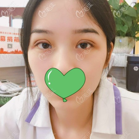 去武漢正璞整形割雙眼皮術(shù)后25天效果 去武漢正璞整形割雙眼皮術(shù)后25天效果