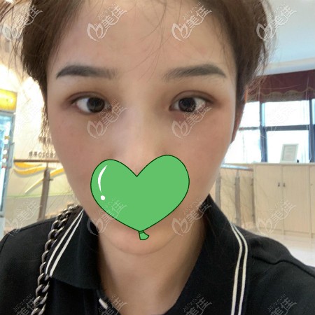 在武漢正璞醫(yī)療美容割雙眼皮2個(gè)月效果 在武漢正璞醫(yī)療美容割雙眼皮2個(gè)月效果