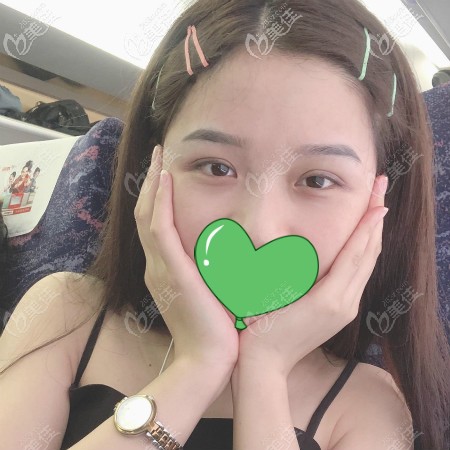 不敢相信！武漢正璞做全切開扇形雙眼皮才6000塊，好看又不貴