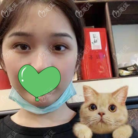 去武漢正璞醫(yī)院割雙眼皮半年恢復(fù)效果圖 去武漢正璞醫(yī)院割雙眼皮半年恢復(fù)效果圖