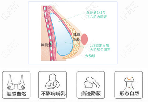 假體植入的位置 假體植入的位置