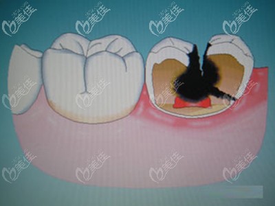 孩子有蛀牙要看情況進(jìn)行治療