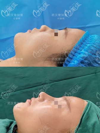 付俊俐隆鼻案例 付俊俐隆鼻案例