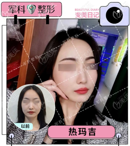 重慶軍科四代熱瑪吉面部案例 重慶軍科四代熱瑪吉面部案例