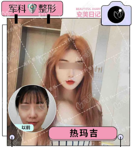 在重慶軍科做了四代熱瑪吉全面部，感覺900發(fā)和1200發(fā)的區(qū)別不在價格