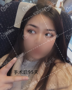 王科醫(yī)生給我做完雙眼皮3個(gè)月了 王科醫(yī)生給我做完雙眼皮3個(gè)月了