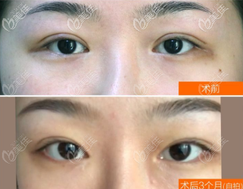 重慶軍科雙眼皮修復(fù)案例 重慶軍科雙眼皮修復(fù)案例