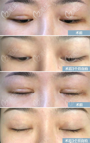 閉眼沒(méi)有疤痕 閉眼沒(méi)有疤痕