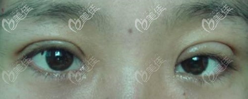 雙眼皮過(guò)深不對(duì)稱修復(fù)