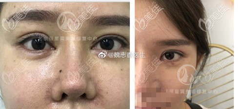 魏志香雙眼皮過(guò)深修復(fù)案例