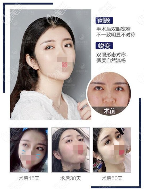 北京米蘭柏羽麗都雙眼皮不對(duì)稱修復(fù)