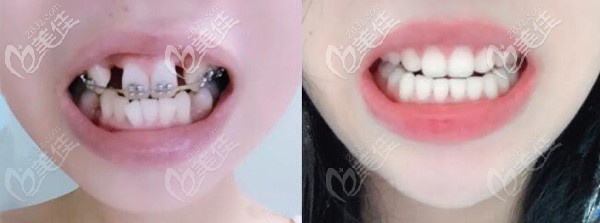 陶李明改善骨性牙凸術(shù)前術(shù)后對(duì)比