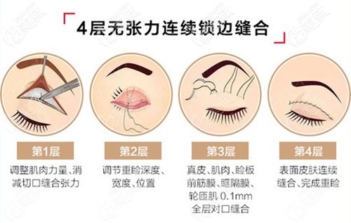 寧波藝星美杜莎眼綜合手術(shù)方法