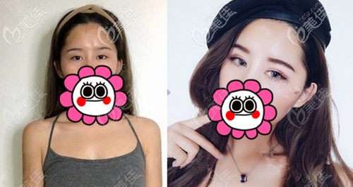 寧波藝星眼綜合手術(shù)案例：