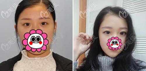 寧波薇琳輕氧CC眼綜合手術(shù)案例