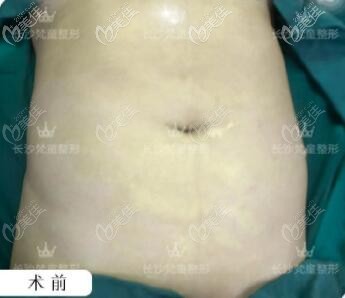 做多維水溶腰腹吸脂術(shù)前照 做多維水溶腰腹吸脂術(shù)前照