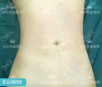 說(shuō)實(shí)話(huà)，看到長(zhǎng)沙梵童多維水溶腰腹吸脂術(shù)后即刻效果讓我蠻吃驚的！
