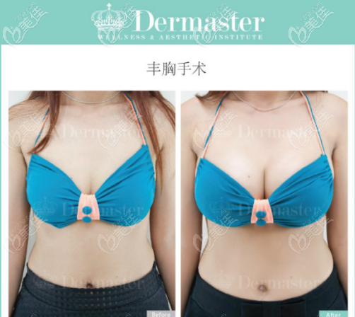 泰國(guó)dermaster整形醫(yī)院曼托假體案例 泰國(guó)dermaster整形醫(yī)院曼托假體案例