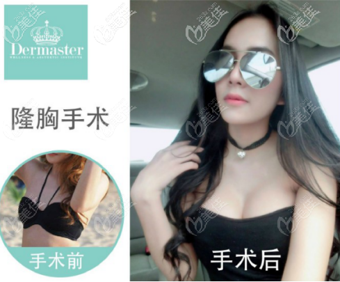 用三個(gè)真人案例回答“泰國(guó)隆胸技術(shù)比國(guó)內(nèi)好嗎？”