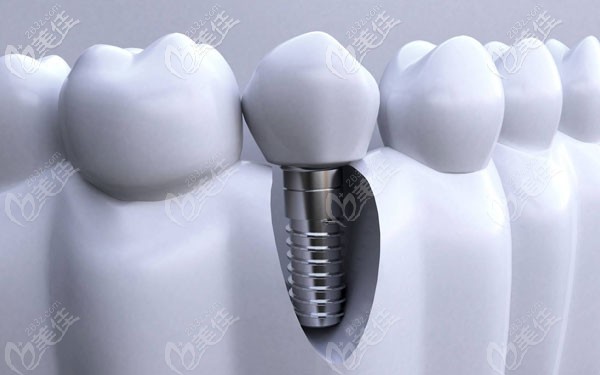 昆明竹子口腔韓國種植牙品牌及價(jià)格