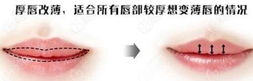 厚唇改薄手術(shù)的效果對(duì)比