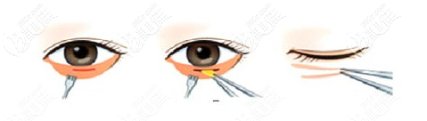 祛眼袋手術(shù)過程示意圖 祛眼袋手術(shù)過程示意圖