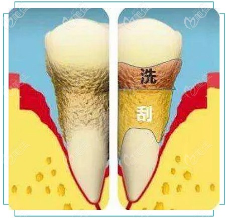 洗牙和牙齦刮治的區(qū)別