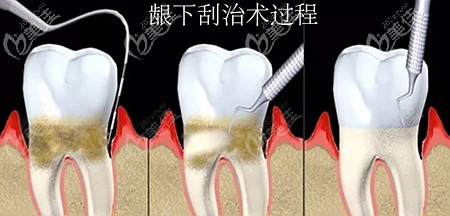 齦下刮治的過程