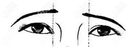 眼距較寬示意圖