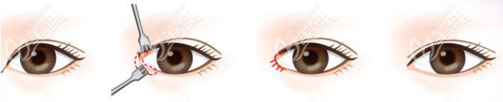 內(nèi)眼角手術(shù)過(guò)程示意圖