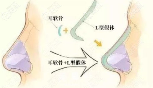 北京星燦宮王佳俊波德黃金三角美鼻術(shù)隆鼻效果示意圖