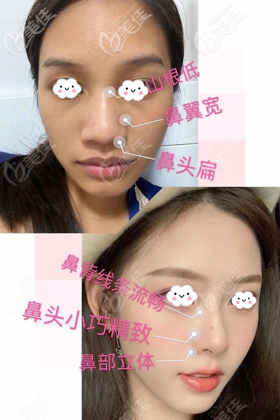 重慶軍美鼻修復(fù)案例