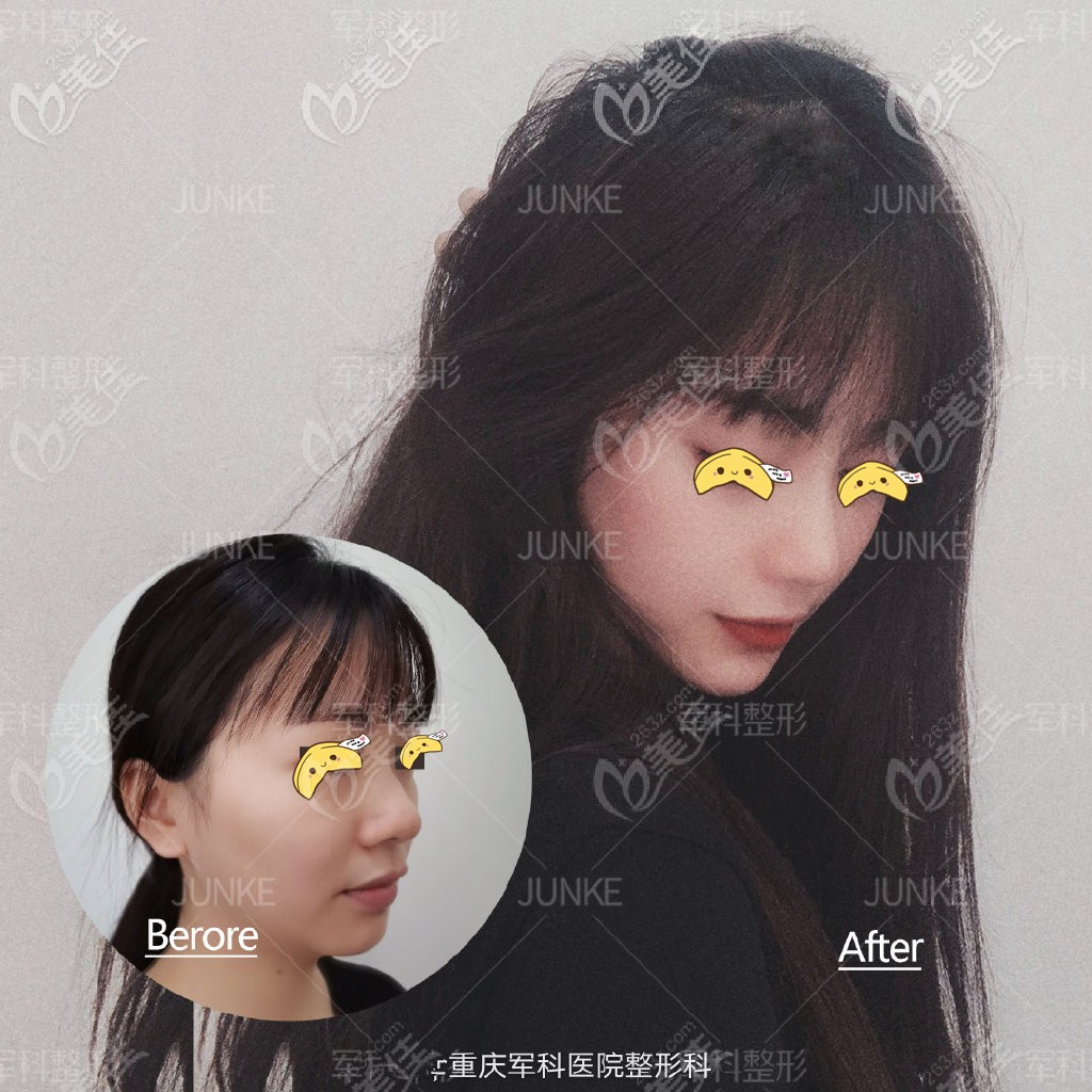 重慶軍科鼻修復(fù)案例