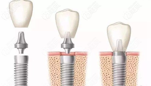 瑞士ITI種植系統(tǒng) 瑞士ITI種植系統(tǒng)