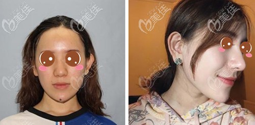 寧波薇琳肋軟骨隆鼻案例 寧波薇琳肋軟骨隆鼻案例