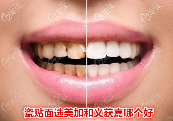 美加和義獲嘉瓷貼面哪個(gè)好