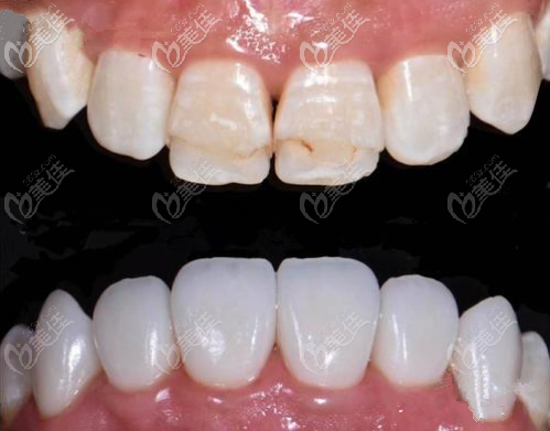 美加瓷貼面效果圖